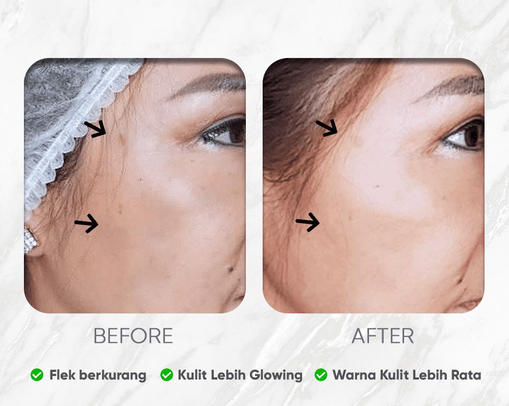 6 Pilihan Treatment Hiperpigmentasi Terbukti Efektif Mengatasi Flek dan Melasma pada Kulit Dewasa