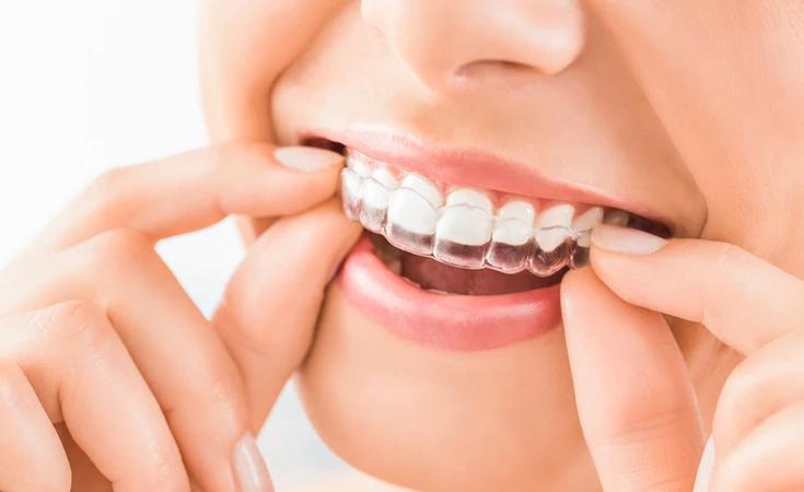 Berapa Biaya Pasang Retainer Gigi Setelah Behel Ini Rincian Harga dan Jenisnya